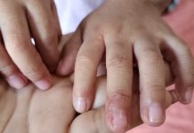 SSM descarta brote de virus de Coxsackie en la entidad