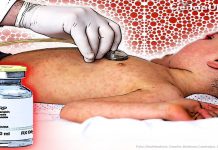 De la erradicación al rebrote: el desafío del sarampión en México